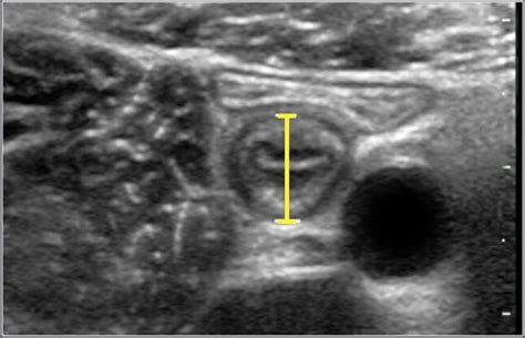 The Radiology Assistant : Normal Values - Ultrasound