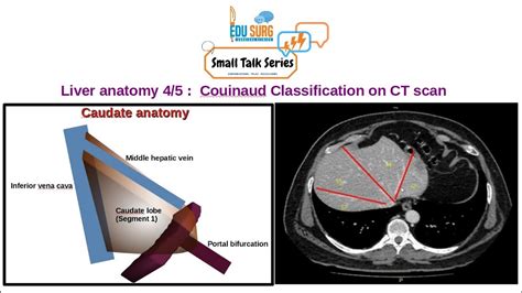 Liver segments CT - Liver anatomy - Caudate anatomy - liver imaging ...