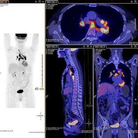 PET/CT scan from May 2016. | Download Scientific Diagram