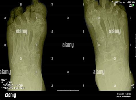 Feet X-ray of an 83 year old male patient suffering from Rheumatoid Arthritis (RA Stock Photo ...