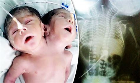 Two-headed baby born with rare condition in India | World | News | Express.co.uk