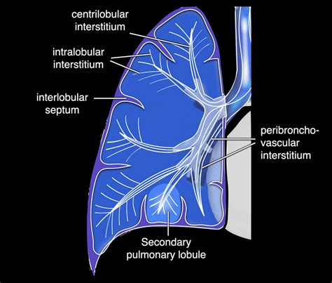 The Radiology Assistant : Pulmonary Fibrosis