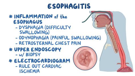 Esophagitis: Clinical: Video, Anatomy & Definition | Osmosis