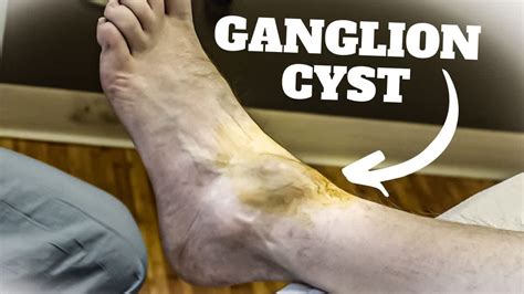 Ganglion Cyst Foot Surgery Recovery Time - The Complete Guide!