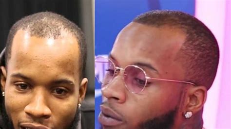 Tory Lanez Hair Transplant - Hair Analysis by Matt Dominance