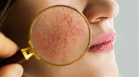 Broken Capillaries On Face: Causes, Results, And Solutions - Doctor Mier