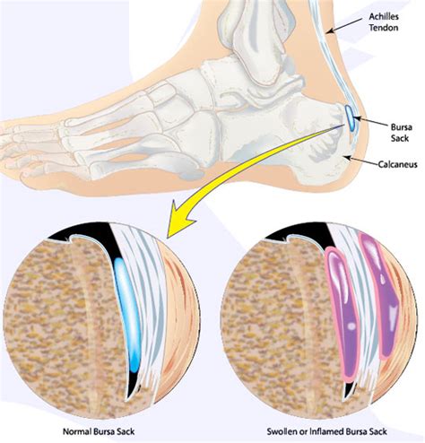 Achilles Bursitis Causes, Symptoms, Treatment