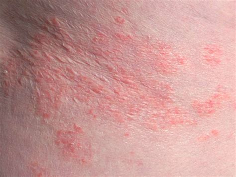 Inverse psoriasis vs. intertrigo: Symptoms, causes, and identification