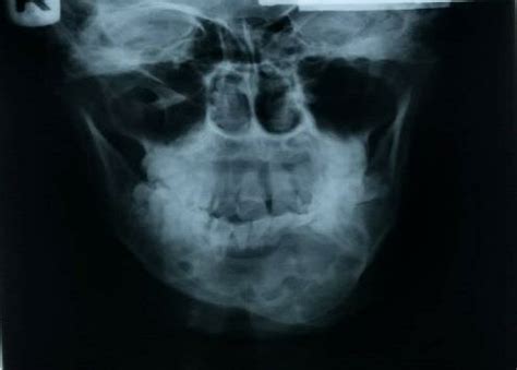 Right and left oblique anterior lateral views and with posterior... | Download Scientific Diagram