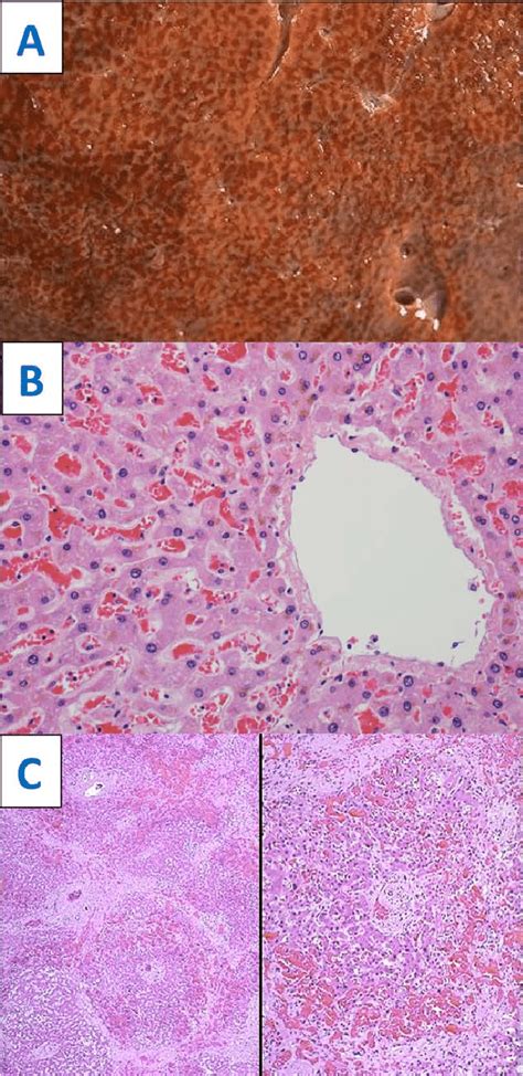 Cardiac (congestive) hepatopathy. (A) Gross photograph of a liver with... | Download Scientific ...