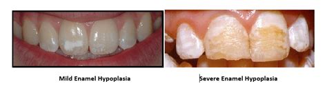 Fixing Enamel Hypoplasia - Auburn Dental