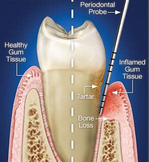 Periodontal Scaling and Root Planing | SRP SRPs | Pasadena TX