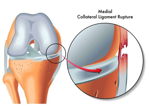 What on earth is a knee MCL sprain? (and how to get rid of it) – Injury Health Blog