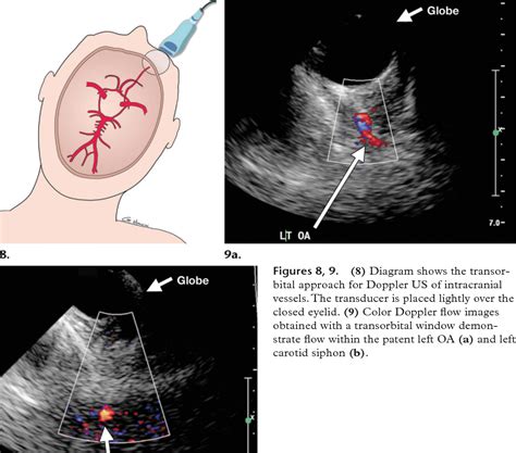 Figure 4 from Advances in transcranial Doppler US: imaging ahead ...