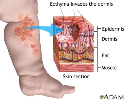 Ecthyma | UF Health, University of Florida Health