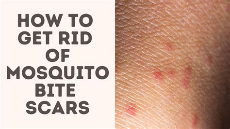 How To Get Rid Of Mosquito Bite Scars - Treat Your Scars