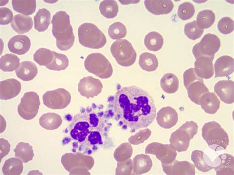 Photomicrographs from a Peripheral Blood Smear