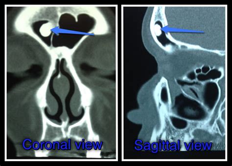 What are Osteomas? - Isaac Namdar, MD