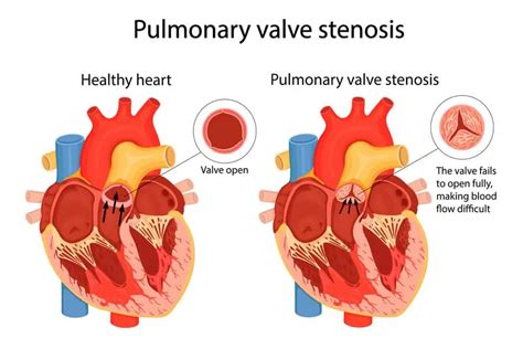 Understanding Pulmonary Valve Stenosis - Longmore Clinic