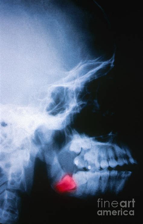 Impacted Wisdom Tooth, X-ray Photograph by Scott Camazine - Fine Art ...