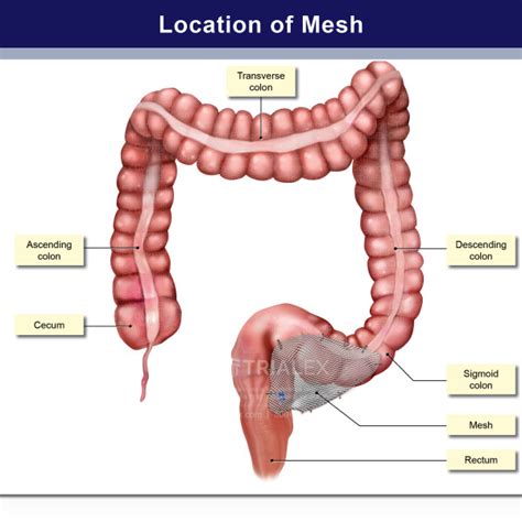 Location of Mesh Near Rectum and Sigmoid Colon - TrialExhibits Inc.