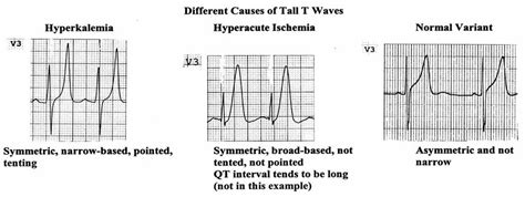 Pedi cardiology: EKG: Tall T waves