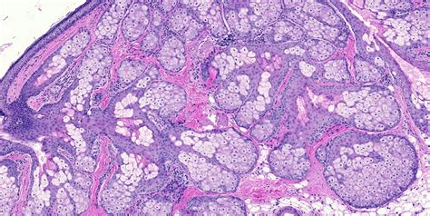 Teratoma Histology