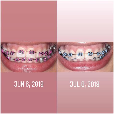 1 month progress : r/braces