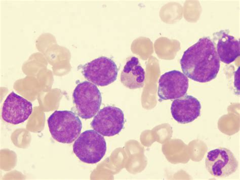 Medical Pictures Info – Acute Lymphoblastic Leukemia