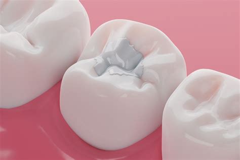 Composite Filling Procedure: Everything You Need to Know