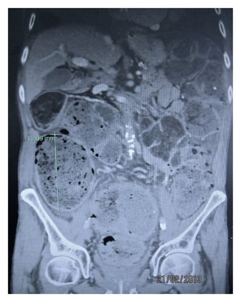 CT abdomen and pelvis demonstrating gross faecal loading and colonic... | Download Scientific ...