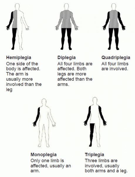 Vivid visual image of Hemiplegia,Diplegia,Quadriplegia,Monoplegia and Triplegia | Physical ...