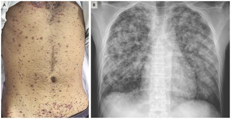 PGIMER doctors report a rare case of Disseminated Varicella Infection