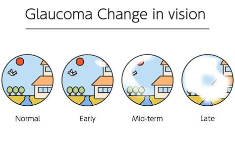 Glaucoma - Utah Eye Centers