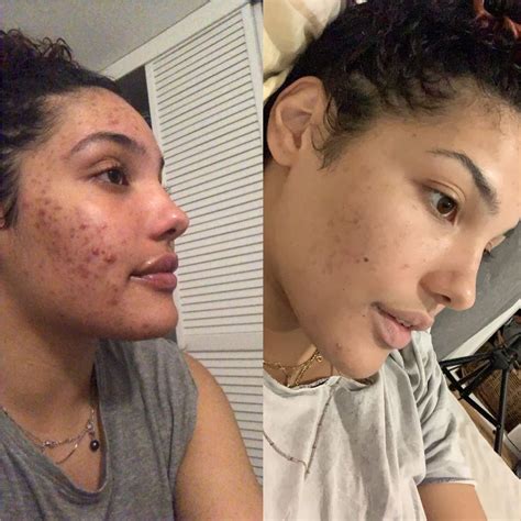 Epiduo before and after 6 months . It gets better!!! : r/acne