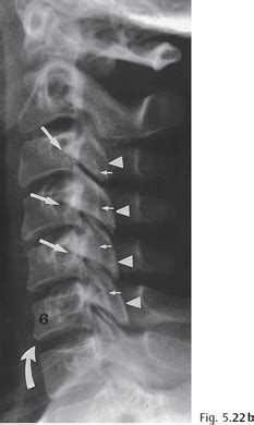 Malalignment: Signs and Significance | Radiology Key