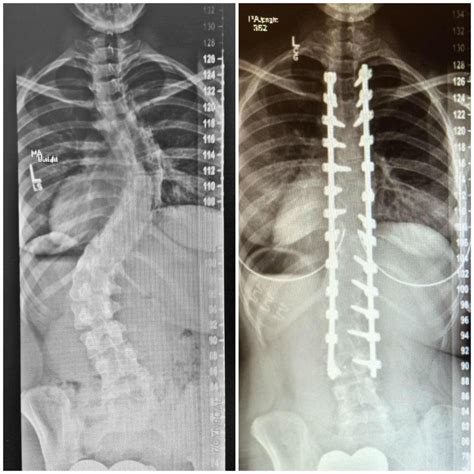 X-rays of my spinal fusion surgery before and after : pics