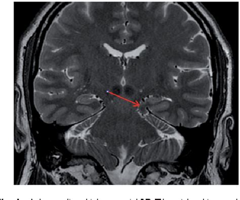 Parahippocampal Gyrus Mri