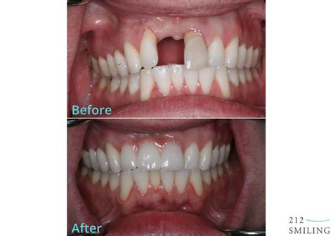 Ceramic Dental Bridge Before and After - 212 Smiling