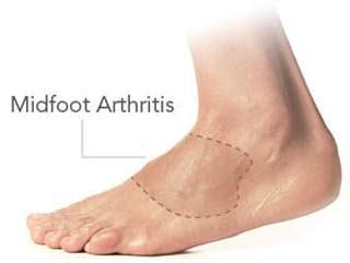 MIDFOOT ARTHRITIS - WESTERN CAROLINA ORTHOTICS AND PROSTHETICS