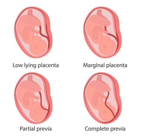 Four Types Of Placenta Previa Concept Illustration 2204021 Vector Art | Hot Sex Picture