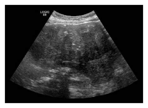 Ultrasound image showing a large pelvic mass. | Download Scientific Diagram