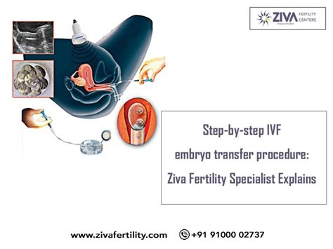 Step-by-step IVF embryo transfer procedure: Ziva Fertility Specialist Explains - Ziva Fertility