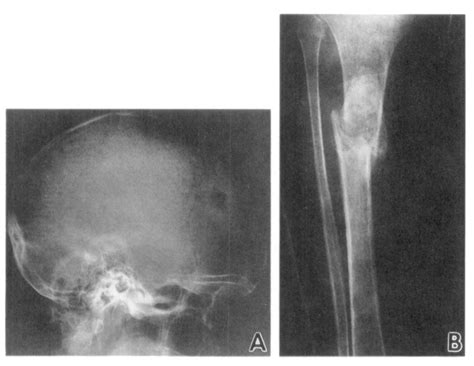 Osteitis Fibrosa Cystica Brown Tumor