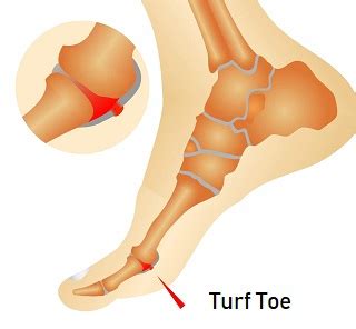 Turf Toe Injury: Causes, Diagnosis & Treatment - Foot Pain Exp