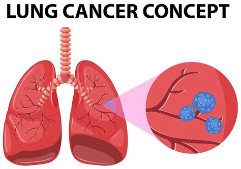 Diagram of lung cancer concept 431523 Vector Art at Vecteezy