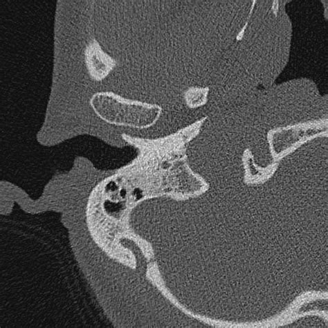 Right high jugular bulb. | Download Scientific Diagram