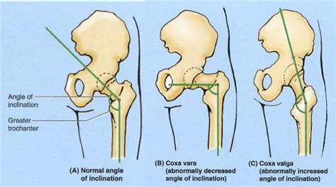 Deadlifting: Picking the Right Version for You Is As Important As ...