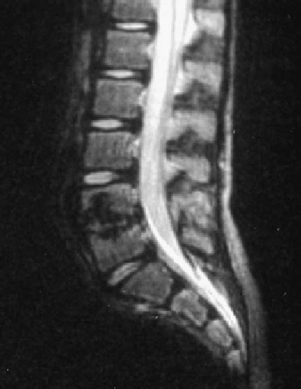 T2-weighted MRI showing deposition of haemosiderin manifesting as a low... | Download Scientific ...