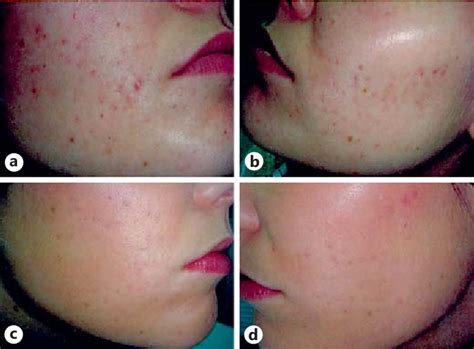 Figure 4 from Azelaic Acid in the Treatment of Acne in Adult Females: Case Reports | Semantic ...